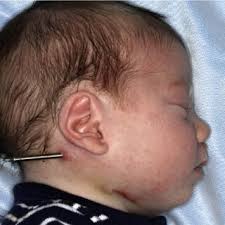 PDF) Precise osteotomies for mandibular distraction in infants with Robin  sequence using virtual surgical planning