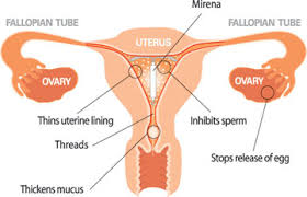When to have mirena removed? Pregnancy After Mirena Removal New Kids Center