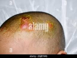 Image result for sores on the head in children