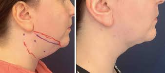 The incredible journey of Berwyn's JP Weber; Why we lost Wayne Sporting  Goods; Real estate rumblings in Radnor; Shipley grad's 'Wild Life'; Claytor  Noone Plastic Surgery; Anti-aging medicine; Personalized test prep &