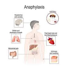 Image result for Anaphylaxis