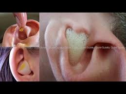 Consider seeing a doctor if you feel a fullness in your ear and you are not comfortable cleaning your ears at home. How To Remove Ear Wax At Home Ear Wax Removal At Home Cleaning Clean Ears Without Cotton Buds Youtube