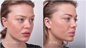 If you are interested in pdo thread lift, korean thread face lift, face lift threading, gold thread face lift, pdo cog lifting thread, pdo thread lift korea, contact us now! Thread Lift Sydney 1 Cosmetic Doctors Face Neck Cheek Lift Specialist Clinic