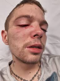 Disabled man left with brain injuries after being battered with hammer