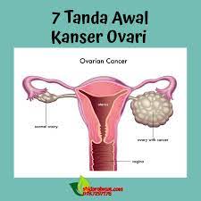 Simptom yang anda alami mungkin bergantung kepada jenis kanser. 7 Tanda Awal Kanser Ovari Shidarahmat