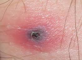 Image result for infected tick bite