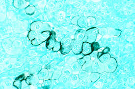 Testicular cancer is the most common cancer in men ages 20 to 35, but highly treatable if caught early. Nitrogen Clearing Enzyme A New Target For Difficult To Treat Pancreatic Cancers Fiercebiotech
