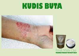 Tumbukisi buah pinang hingga lumat dan kemudian campurkan dengan sedikit minyak kelapa. Soleehaa Anggun Beauty Tips Menghilangkan Kudis Buta Dengan Cepat