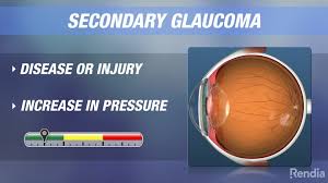Glaucoma meaning, definition, what is glaucoma: Secondary Glaucoma Brightfocus Foundation