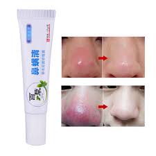 How to treat acne rosacea language:de. Herbal Anti Nose Mites Remove Acne Rosacea Cream Red Nose Blackhead Remover Acne Treatment Shrink Pores Face Bleaching Ointment Body Self Tanners Bronzers Aliexpress