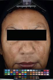 Dermatological Nursing, Volume:23. Issue: 3 by BDNG