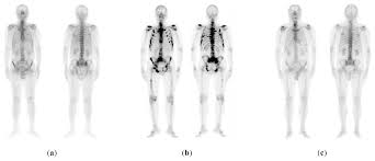 It may grow slowly and it's typically treatable. Healthcare Free Full Text A Lightweight Convolutional Neural Network Architecture Applied For Bone Metastasis Classification In Nuclear Medicine A Case Study On Prostate Cancer Patients Html