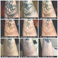 And for per treatment, you will need to spend $200 to $2000, which is the average laser tattoo removal cost. My 2 Year Progress So Far You Can See After The 5th Session Is When I Started Getting Hyper Pigmentation The Tattoo Turned Into A Brown Blob Taking Some Time Off From