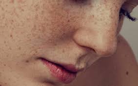 Image result for Solar Lentigo