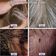 Removing all lice and nits from the hair would end the infestation immediately. Head Lice Eggs Pictures Picture Gallery Liceeggspicture Com Head Louse Lice Removal Eggs Pictures