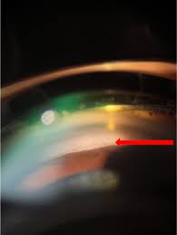 Image result for Gonioscopy