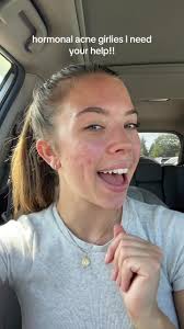 give me all your recomendations because your girl is strugglingggg  #hormonalacne #acne #acneskin #skincaretips #helpthisgoviral #forthegirlies  #relatable