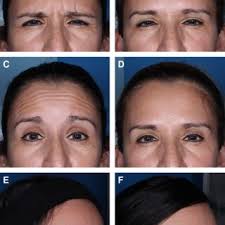 The difference in the number of units injected between older versus...