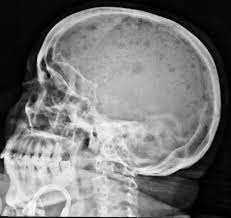 This algorithm is currently undergoing updates by the faculty of the myeloma center at the. Multiple Myeloma Radiology Case Radiopaedia Org