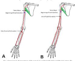 Learn vocabulary, terms and more with flashcards, games and other study tools. Termination Of The Brachial Artery In The Arm And Its Clinical Significance Semantic Scholar