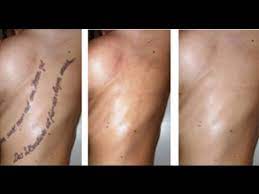 In general, you'll gently wash the tattoo with unscented, mild soap three times a day — without soaking — for the first three days after you remove the bandage. How To Remove Tattoos Without Laser Treatment Youtube