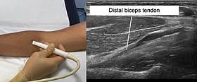 Image result for Biceps Tendon Injection