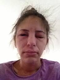31 Allergic Reactions That Actually Hurt To Look At