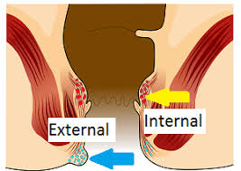 Image result for hemoroid human