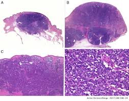 Merkel cell carcinoma is a rare cutaneous neoplasm most commonly affecting the head and neck of elderly white patients. Update On Merkel Cell Carcinoma Epidemiology Etiopathogenesis Clinical Features Diagnosis And Staging Actas Dermo Sifiliograficas