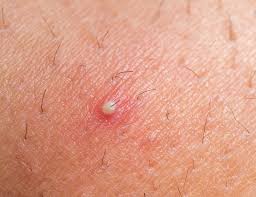 An ingrown hairis one that's grown back into your skininstead of rising up from it. Electrolysis For Ingrown Hair