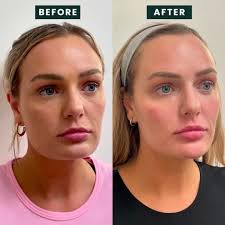 Micah Lib Before and After