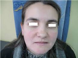 Image result for demodex rosacea