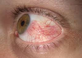Image result for Acute Red Eye