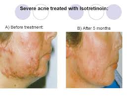 Check spelling or type a new query. Treatment Of Acneii Classification Of Acne Grade Of