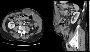 Your doctor may consider these factors when choosing a diagnostic test Extraperitoneal Parastomal Metastasis Of Malignant Peritoneal Mesothelioma Bmj Case Reports