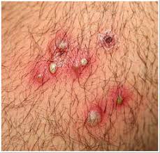 Ingrown hair can be caused due to hair removing methods, hair texture etc. Infected Ingrown Bikini Line Hair