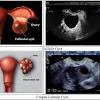 Signs of ovarian cyst rupture. Https Encrypted Tbn0 Gstatic Com Images Q Tbn And9gctnseyj8p2hmuqmf8krjyrqc8pwj18cu2is2ripdlppp7q63dws Usqp Cau