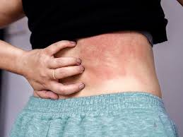 Image result for zoster under breasts