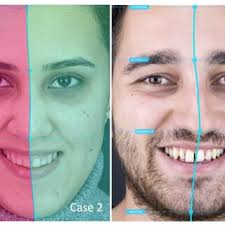 Original image and 3 modifications of right central incisor gingiva...