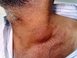 It's been swollen for about 2.5 weeks now. Virchow S Node Bmj Case Reports