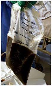 A major part of treatment for pleural effusion is primarily concentrated on. Black Pleural Fluid Obtained From Ultrasound Guided Thoracentesis Download Scientific Diagram