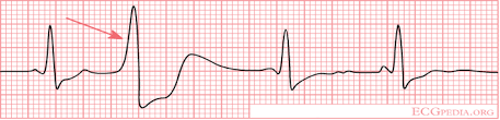 On an electrocardiogram, or ecg, which measures the electrical activity of the heart via electrodes that are placed on the skin, the atrial depolarization and its. 03 08 Premature Ventricular Contraction Pvc Nursing Com