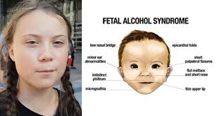 When i pull my lids downwards i get a epicanthical fold but i want to. Does Greta Thunberg Have Fetal Alcohol Syndrome