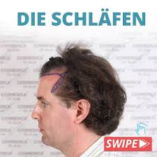 Trotzdem stehen einige patienten der haartransplantation in istanbul noch immer skeptisch gegenüber. Die Schlafen Sind Der Schwierigste Aber Auch Wichtigste Teil Wahrend Des Transplantationsprozesses Bei Diesem Patienten Siehst Du Ein Sehr Naturliches Ergebnis Welches Auf Den Herausfordernden Schlafenbereich Zuruck Zu Fuhren Ist Wenn Wir