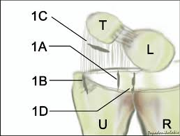 Tenderness in the soft spot between the ulnar styloid and flexor carpi ulnaris tendon, between the volar surface of the ulnar head and the pisiform 95% sensitivity and 87% specificity for foveal disruptions of tfcc or ulnotriquetral ligament injuries pain elicited with ulnar deviation (tfcc compression) or radial deviation (tfcc tension) Palmer Classification Of Tfcc Traumatic Injuries A Vertical Tear 2 Download Scientific Diagram