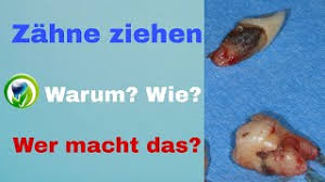 Als zahn ziehen bezeichnet man das entfernen eines zahnes (zahnextraktion, exodontie) ohne weitergehende operative maßnahmen. Zahn Ziehen Zahnentfernung Zahnextraktion Wie Wer Und Warum Werden Zahne Gezogen Youtube