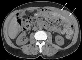 Mesothelioma what's malignant mesothelioma cancer. Primary Mesothelioma In A 52 Year Old Man Ct Image Shows A Thin Download Scientific Diagram