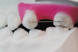 One of the methods to correct class ii malocclusion is to distalize upper molars. Https Pdfs Semanticscholar Org Bc8e 821887fcf0e7cbbdc03d26f1a512e21996fc Pdf
