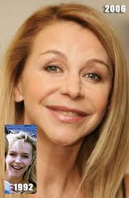 Eyes., men behaving badly, where the heart is and holby city. The Curse Of Leslie Ash Her Trout Pout Permanent Dermal Fillers Cause Permanent Problems