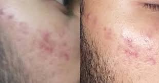 Sunspots, also known as liver spots or solar lentigines, are very common.anyone can get sunspots, but they are more common in people with fair skin and those older than 40. How To Remove Red Spots From My Face Girlsaskguys